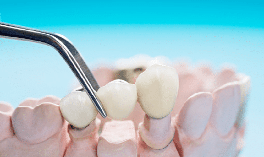 How Dental Crowns Can Benefit Your Smile?