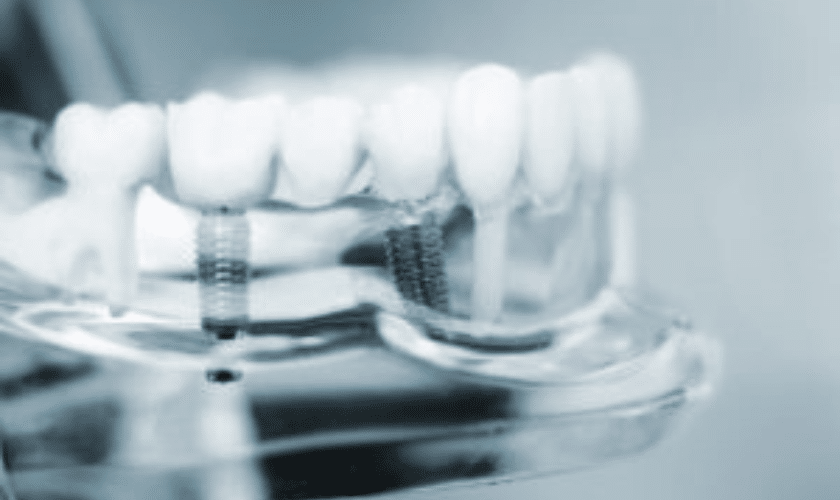 Things To Know Before Getting Dental Implant Surgery