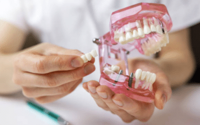 Dentures & Bridges: All You Need To Know