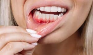 Gum Disease Treatment