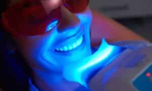 teeth whitening