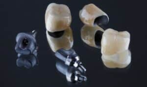 Dental Crowns