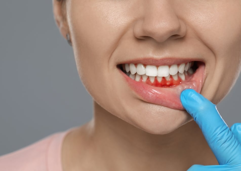 Gum Disease Treatment Lubbock