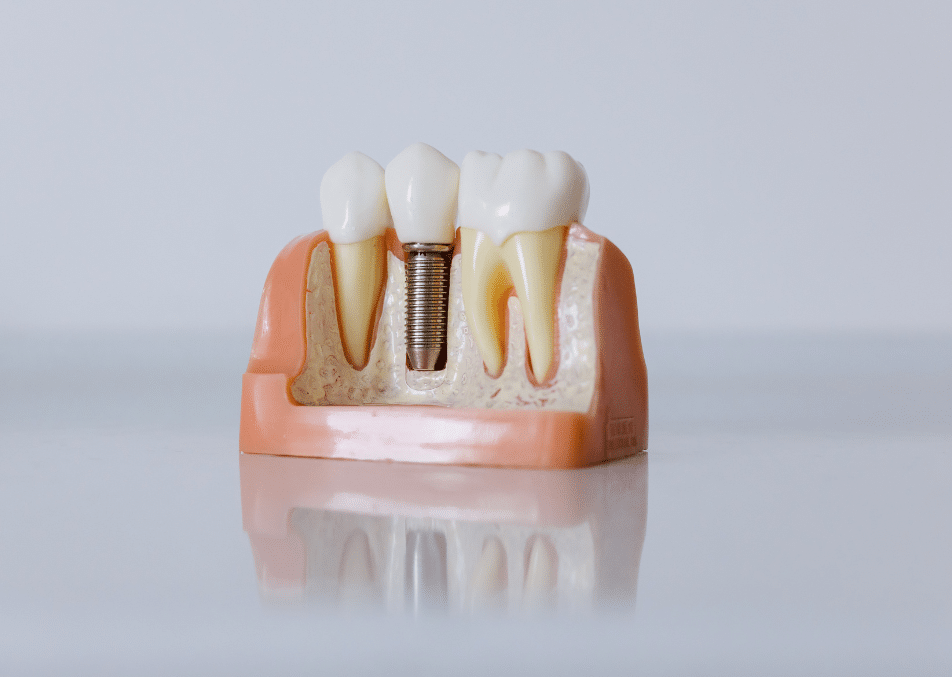 Dental Implants Lubbock 