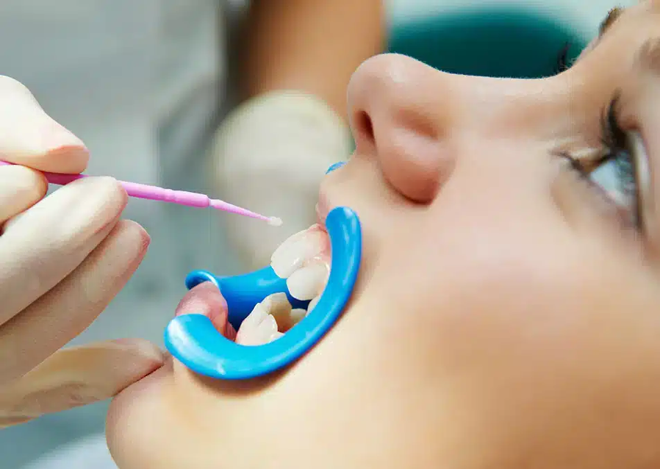 Dental Sealants Lubbock Dental Sealants Lubbock